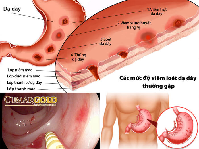 Viêm xung huyết hang vị