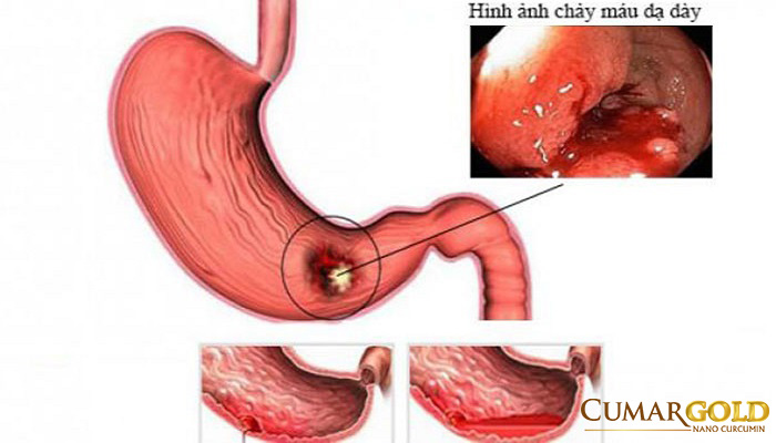 Xuất huyết dạ dày