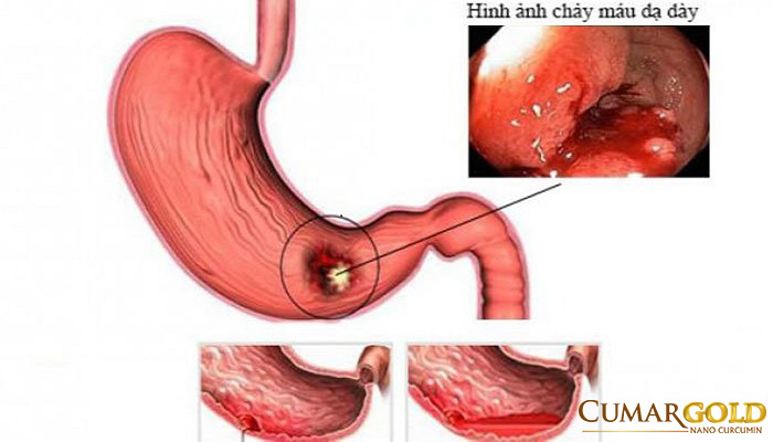 Xuất huyết dạ dày