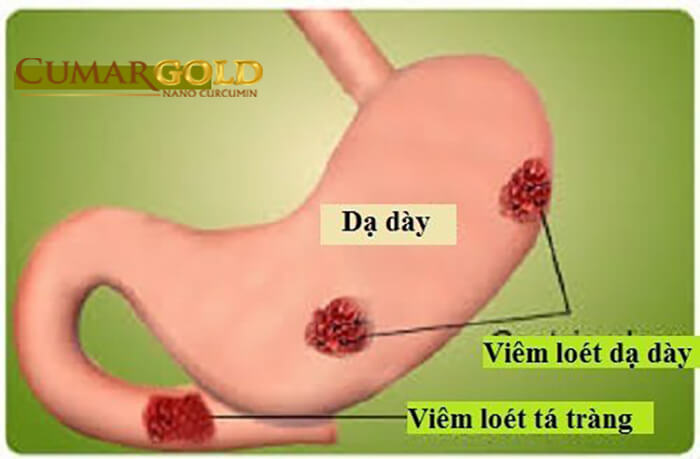 Bệnh viêm dạ dày tá tràng