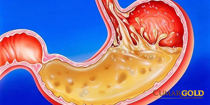 Acid dịch vị tiết ra nhiều là một trong những nguyên nhân gây loét dạ dày