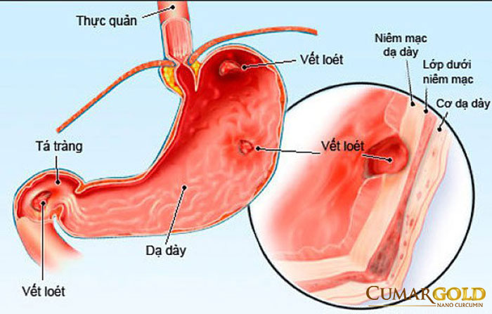 Hình ảnh viêm loét dạ dày tá tràng