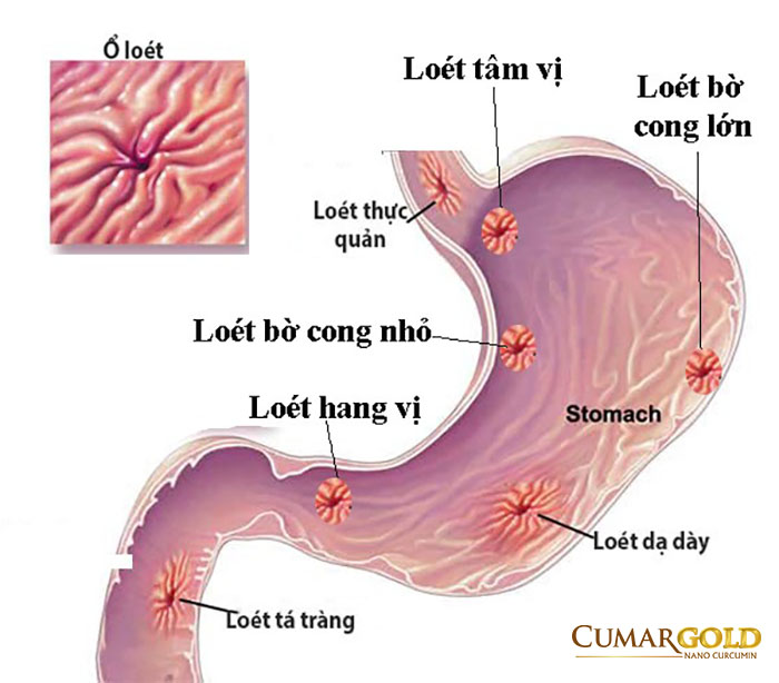 Loét dạ dày hay xảy ra ở vị trí nào?