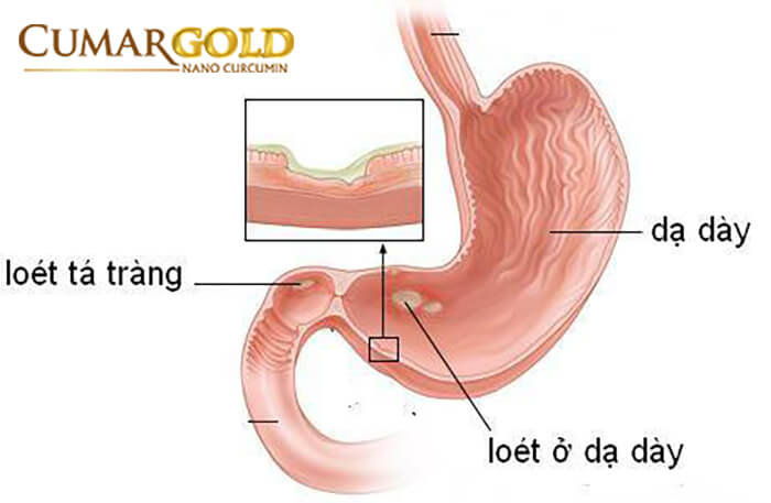 Viêm dạ dà tá tràng