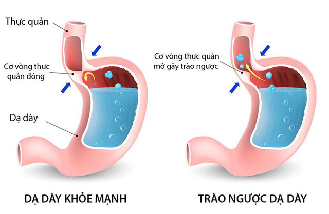 Viêm dạ dày thực quản trào ngược là gì?