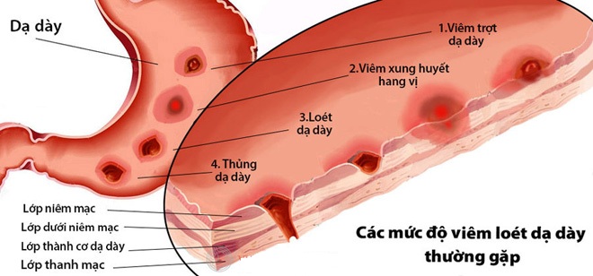 hình ảnh viêm loét dạ dày tá tràng