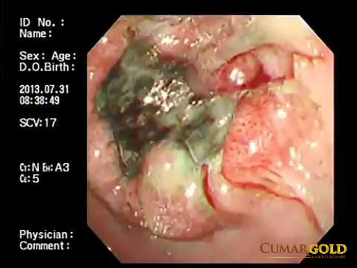 Hình ảnh ung thư dạ dày qua nội soi