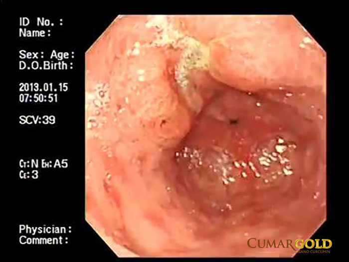 Ảnh viêm trợt phù nề hang môn vị