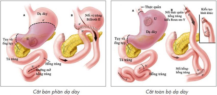 phẫu thuật cắt dạ dày