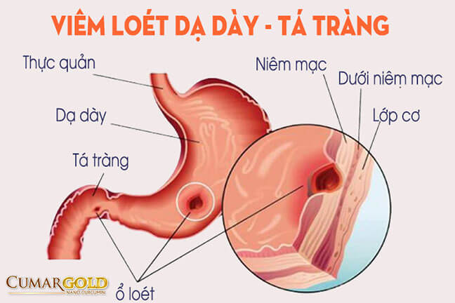 Viêm loét dạ dày - trá tràng là tổn thương gây viêm và loét niêm mạc dạ dày hoặc tá tràng