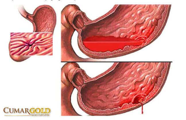 Biến chứng nguy hiểm của đau dạ dày