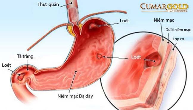 Kiến thức chung về viêm dạ dày