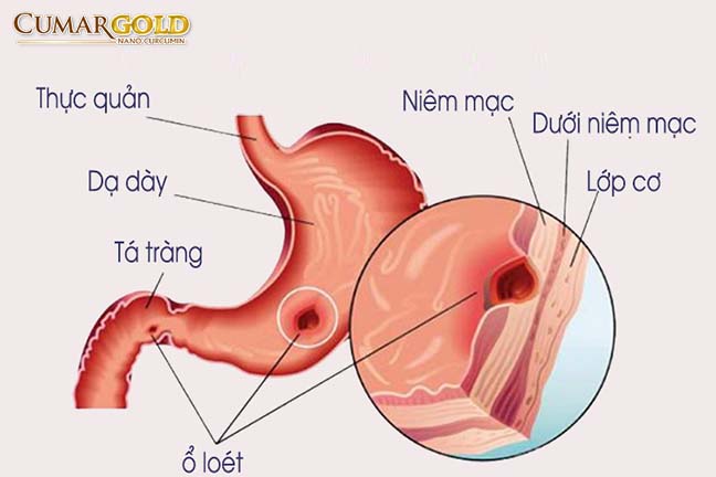 Viêm dạ dày K29 là gì?