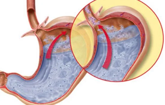 Cơ thắt thực quản bị suy giãn làm acid dạ dày trào ngược lên
