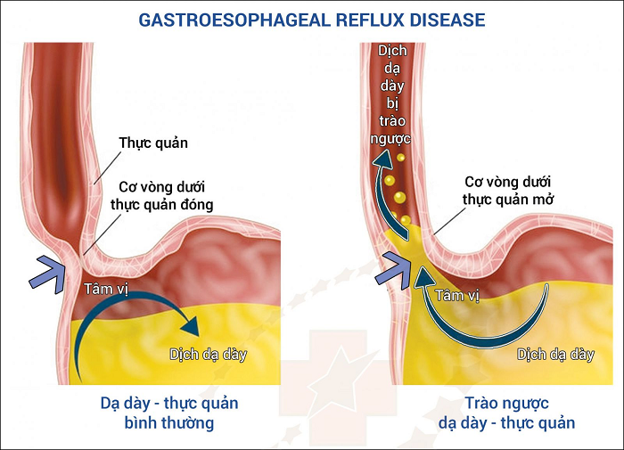 Dịch vị dạ dày trào ngược lên thực quản